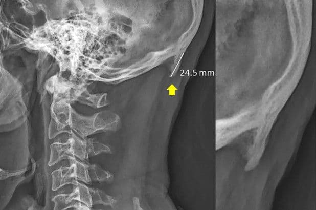 मोबाईल जास्त वापरला म्हणून लोकांना शिंग फुटत आहे ?? काय आहे हे प्रकरण ??