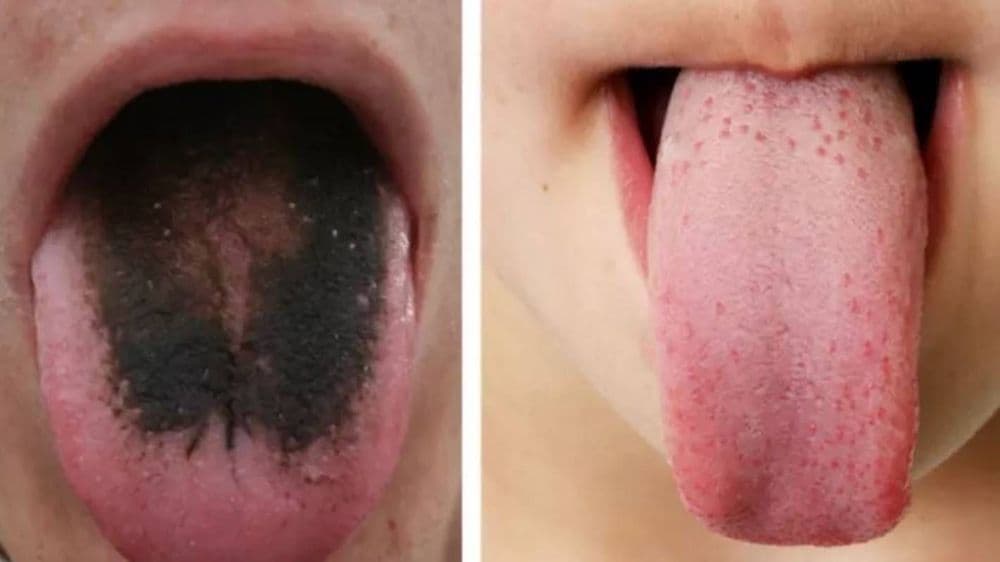 बापरे !! चक्क जिभेवर केस आले ? वाचा कशाचा साईड इफेक्ट आहे हा !!