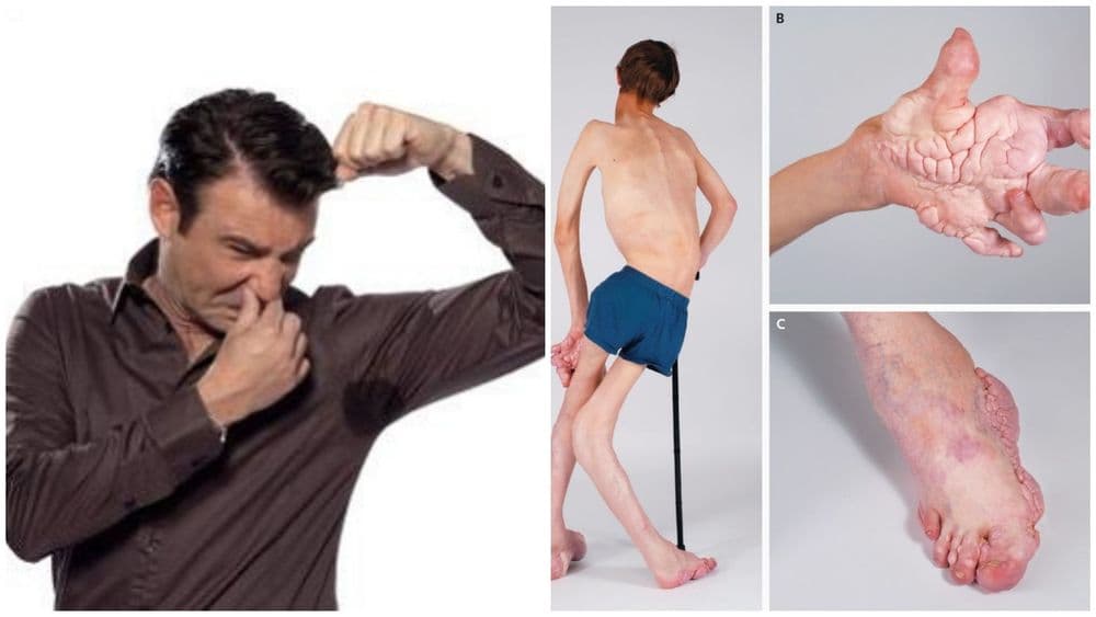 असे पाच अविश्वसनीय आजार ज्यावर तुमचा विश्वासच बसणार नाही !!