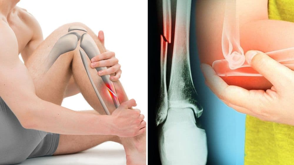 फ्रॅक्चरचे १५ प्रकार, तुमचं यातल्या कुठल्या प्रकारचं फ्रॅक्चर झालं होतं??