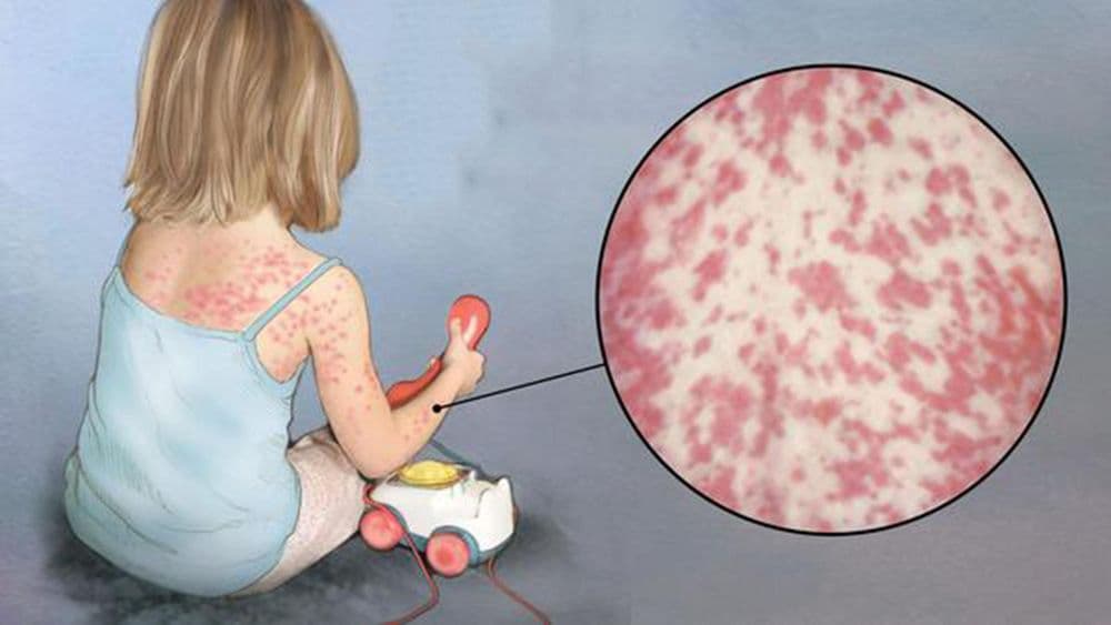 जगभरात उफाळलेली गोवराची साथ भारतात आली तर ? काय काळजी घ्याल ?