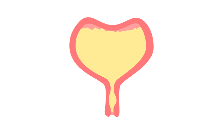 ४. झोपेत शु होण्यामागचं एक प्रमुख कारण मूत्राशयाचा आकार लहान असणं हेही एक असू शकतं. मूत्राशय किडनीतून येणारं मुत्र साठवण्याचं काम करत असतं. जर त्याचा आकार लहान असेल तर वारंवार शु होऊ शकते. याखेरीज मूत्राशयाचा अशक्तपणा हे दुसरं कारण असू शकतं.