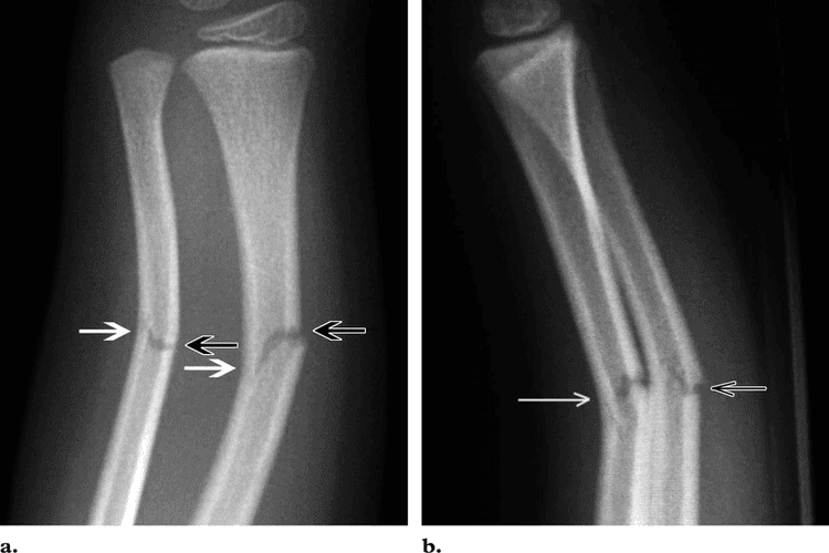 Greenstick Fracture - एका बाजूने फ्रॅक्चर, पण हाड वाकल्याने ते पूर्ण न तुटणे. हे फ्रॅक्चर लहान मुलांमध्ये जास्त आढळून येते कारण त्यांची हाडे लवचिक असतात.