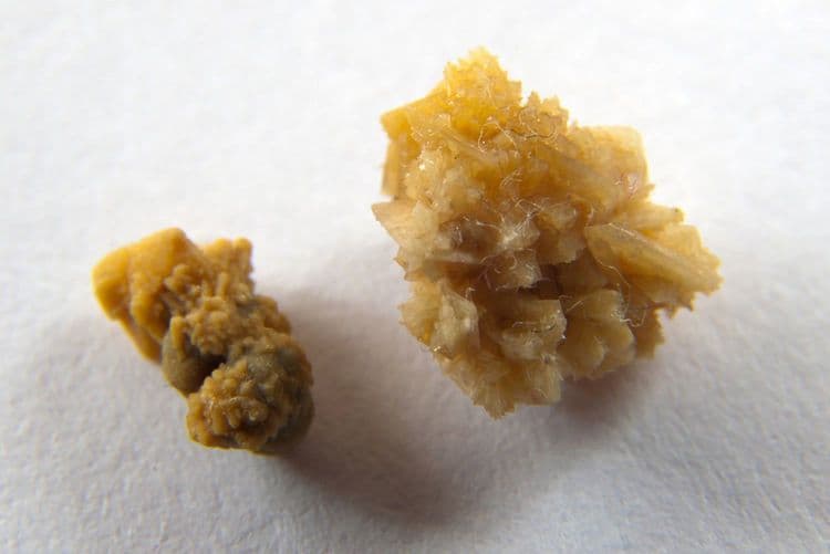 युरीक ॲसिड स्टोन्स