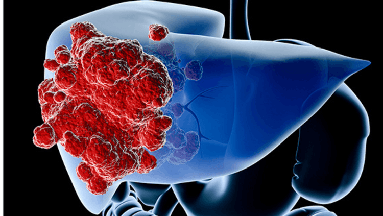 २ यकृताचा कर्करोग