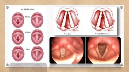प्युबरफोनिया होण्याची कारणे