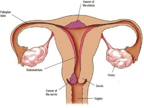 ३ योनीमार्ग आणि गर्भाशय यांना जोडणाऱ्या ग्रीवेचा कर्करोग
